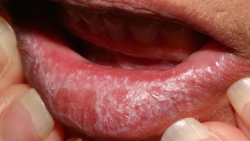 Liken phẳng ở miệng là một tình trạng viêm mạn tính (lâu dài) ở miệng