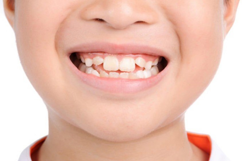 Răng sữa mọc lệch ở cả 2 hàm