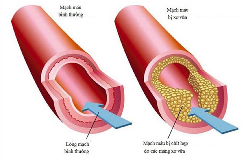 Dùng kiều mạch giúp giảm cholesterol và huyết áp Dùng kiều mạch giúp giảm cholesterol và huyết áp
