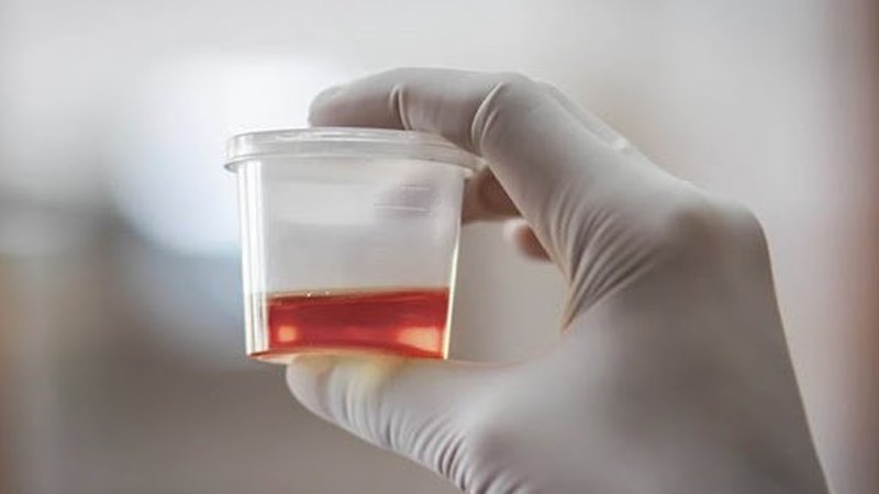 Tiểu ra máu là một trong những biến chứng của viêm bàng quang