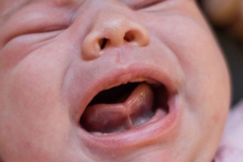 Bệnh lý dính thắng lưỡi khiến trẻ 3 tuổi chậm nói