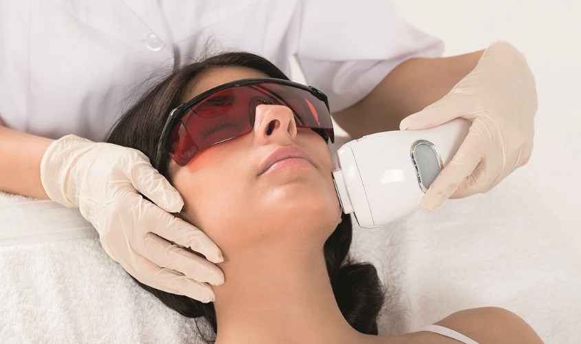 Phương pháp triệt lông mặt bằng tia laser 