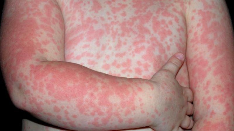 Sốt phát ban điển hình với triệu chứng sốt và phát ban