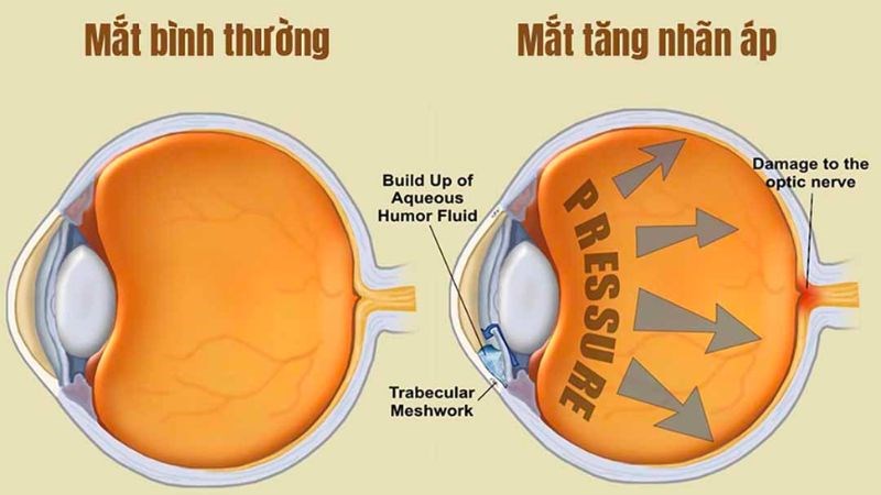 Tăng nhãn áp là gì?