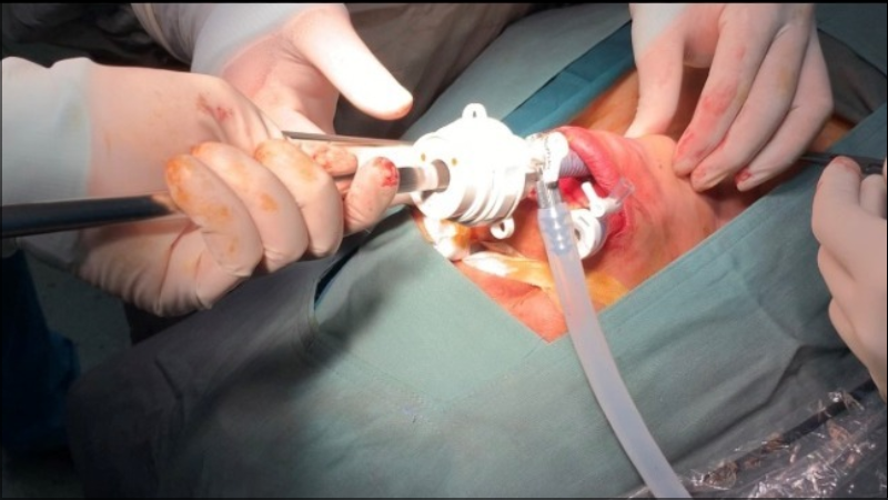 Phẫu thuật nội soi cắt tuyến giáp bằng đường miệng