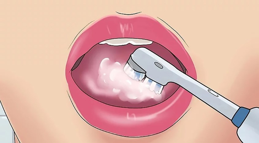 Chải lưỡi và vòm miệng để loại bỏ các mảnh vụn và vi khuẩn Chải lưỡi và vòm miệng để loại bỏ các mảnh vụn và vi khuẩn