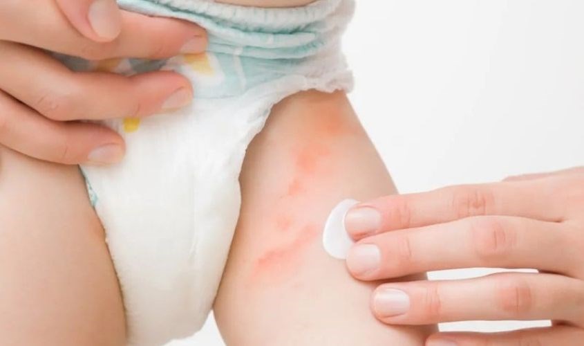 Dùng bỉm Pampers hêt hạn sử dụng gây nên tình trạng dị ứng Dùng bỉm Pampers hêt hạn sử dụng gây nên tình trạng dị ứng