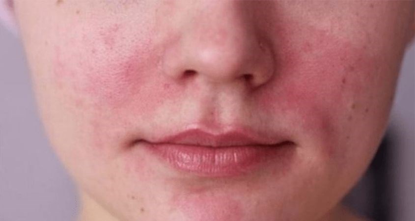 Nếu bạn sử dụng dầu cá kém chất lượng, da mặt của bạn sẽ rất dễ bị kích ứng.