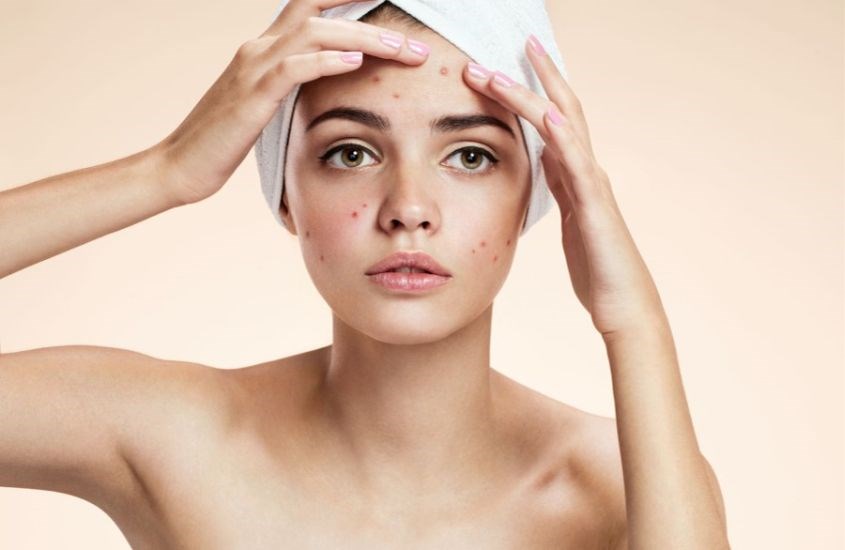 Dưỡng chất từ dầu cá giúp giảm thâm mụn, mờ sẹo vô cùng hiệu quả