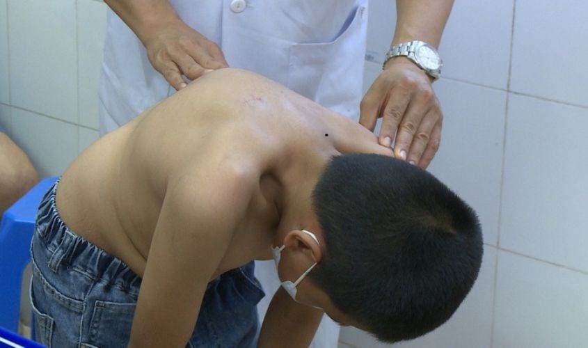 Nguyên nhân và hệ quả của bệnh gù lưng