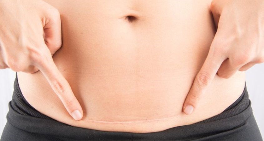 Mẹ sinh mổ nên đợi vết mổ lành hẳn rồi mới bắt đầu dùng đai nịt bụng