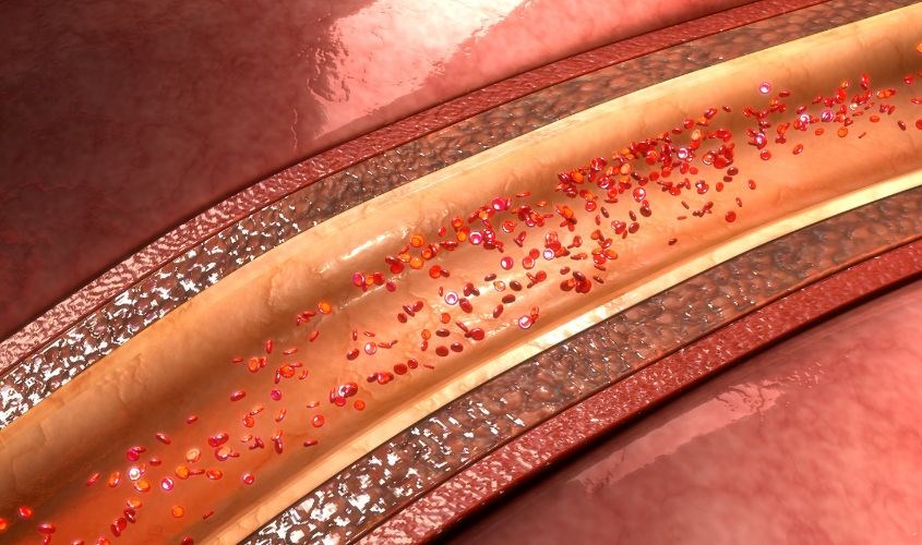 Yến chưng đông trùng hạ thảo giúp hạn chế xơ vữa động mạch