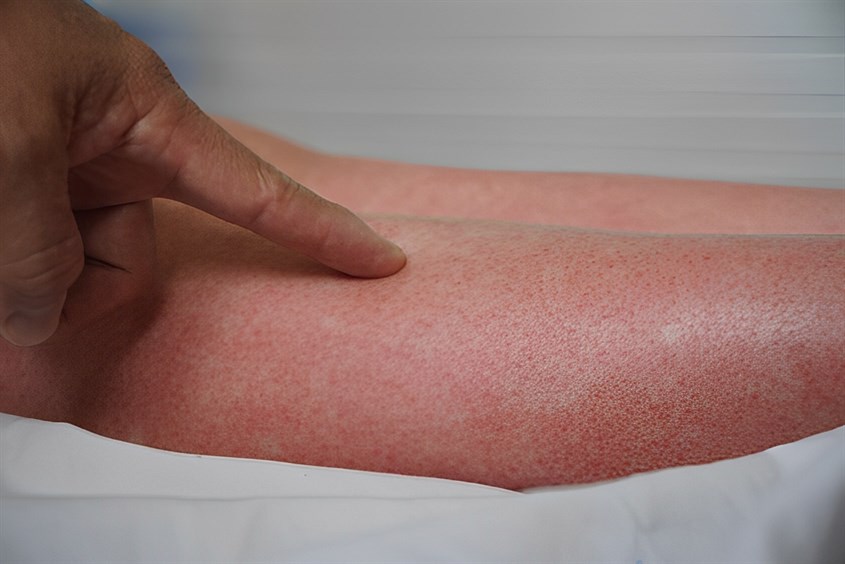 Phân biệt sốt phát ban và sốt xuất huyết