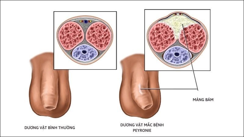 Bệnh Peyronie khiến dương vật đau nhức, khó chịu 