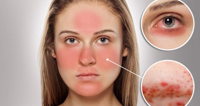 Dị ứng da mặt là hiện tượng trên da xuất hiện những vết chấm đỏ, có thể như các vết mụn, mề đay hay là mụn viêm