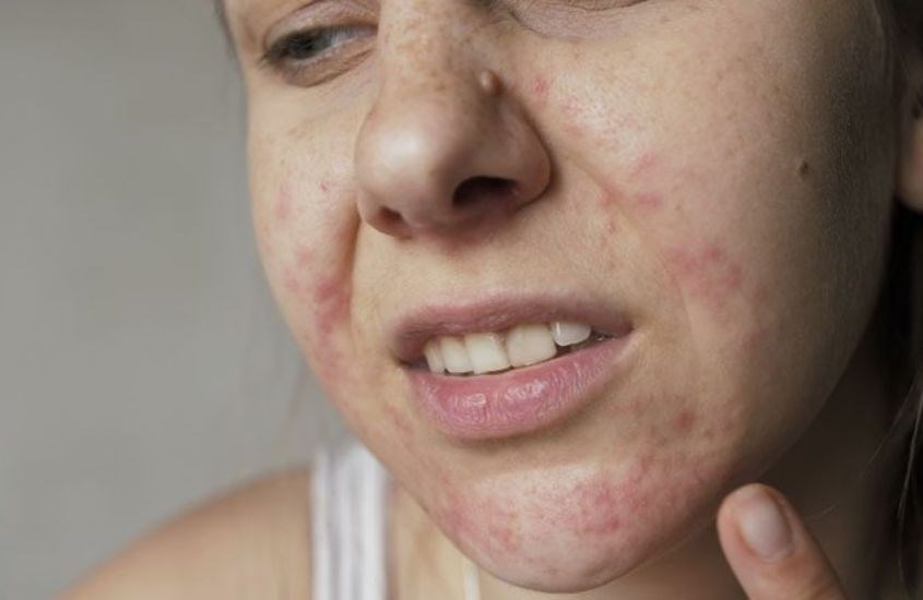 Ngưng sử dụng ngay khi có những dấu hiệu kích ứng