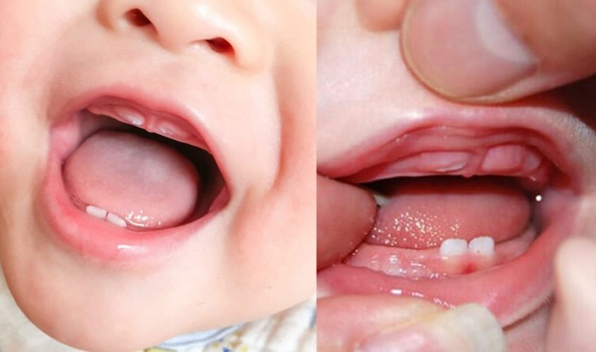 Trẻ sơ sinh bị dính thắng môi trên có sao không?