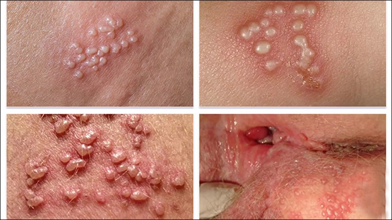 Patients can recognize genital herpes by signs of single blisters or clustered growth.