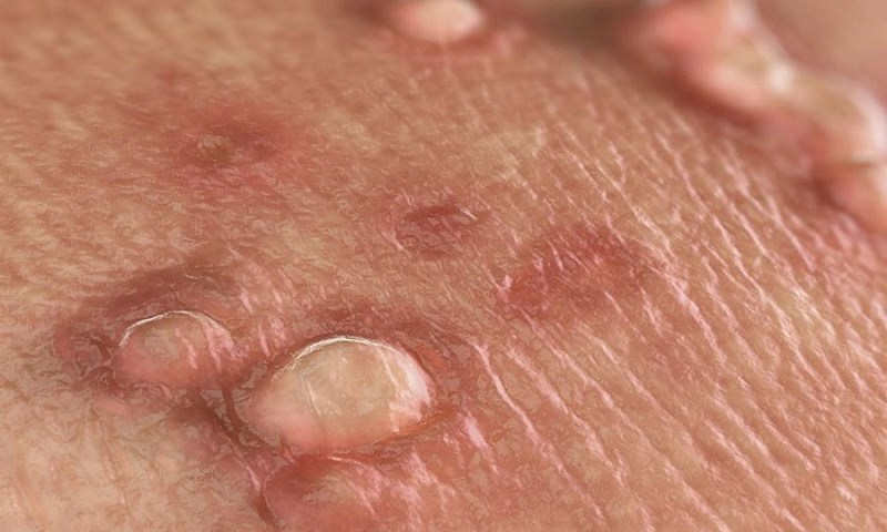 The incubation period of genital warts averages from 1 to 8 months