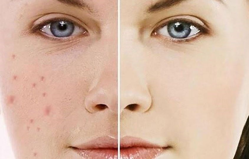 Làm mờ vết thâm mụn