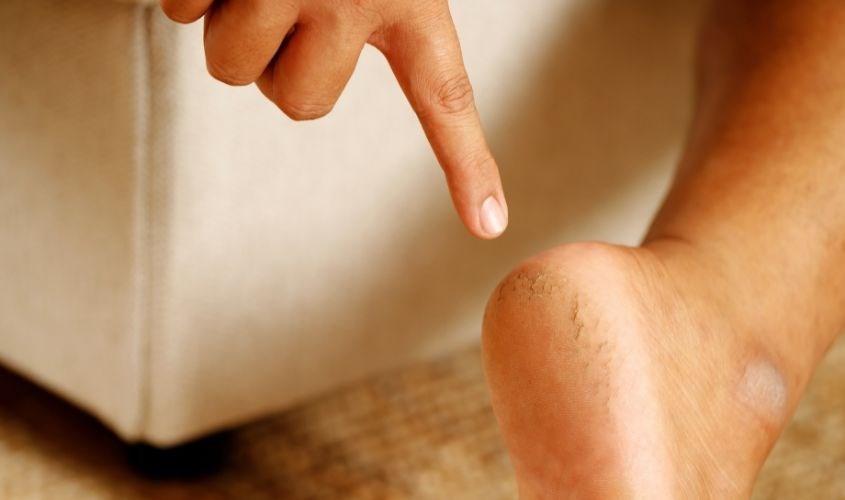 Thời tiết lành và đi đứng nhiều là nguyên nhân gây ra nứt gót chân