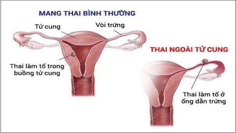 13-bien-chung-thai-ky-me-bau-can-luu-y-de-tranh-khoi-11