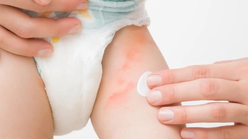 3 cấp độ hăm tã nhẹ