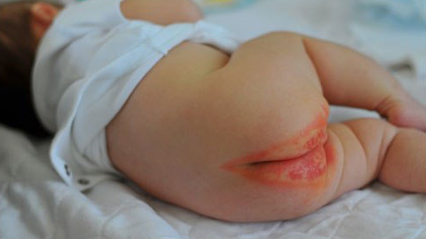 Dấu hiệu hăm tã nặng