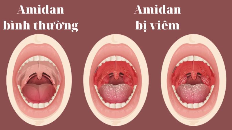 Viêm amidan có thể kéo dài gây ảnh hưởng đến người bệnh