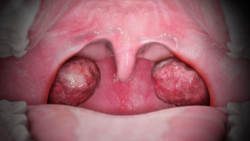 Viêm amidan là tình trạng sưng tấy, viêm nề tại amidan 