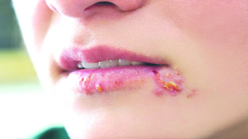 Virus herpes có thể bị lây truyền qua tuyến nước bọt