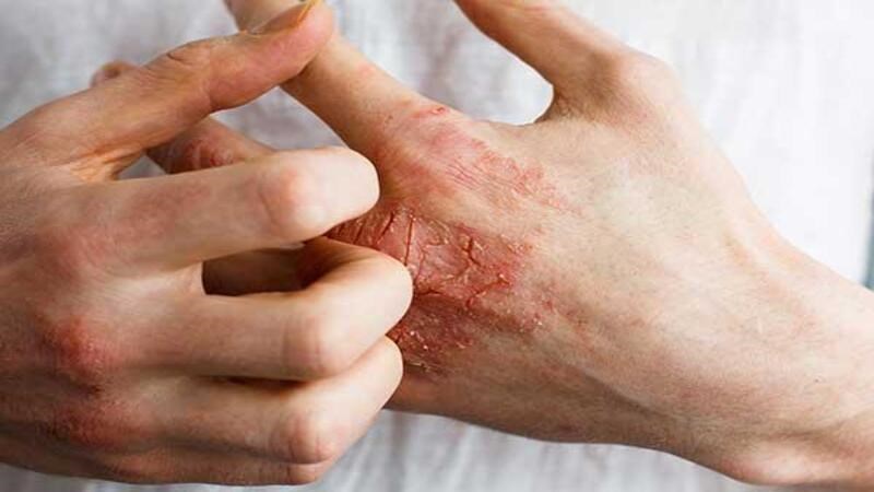 Người bị tình trạng da mạn tính thường có xu hướng phát triển nhiễm trùng nấm