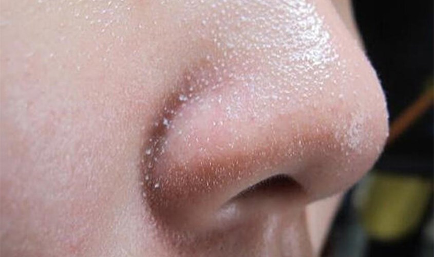 Sợi bã nhờn Sợi bã nhờn