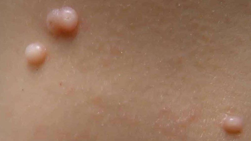Nổi hạt hình tròn có màu da
