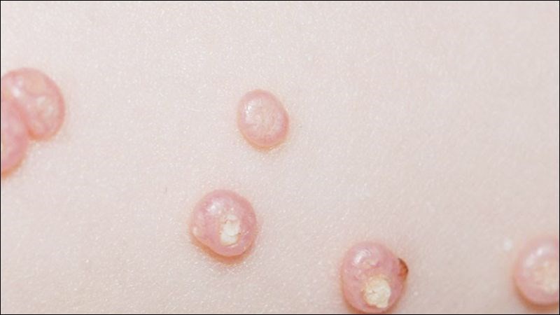 U mềm lây có thể tự khỏi mà không cần điều trị