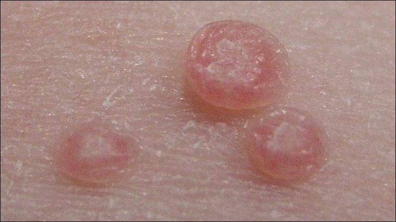 U mềm lây là bệnh nhiễm khuẩn thường gặp ở trẻ em