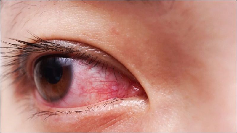U mềm lây có thể dẫn tới viêm kết mạc