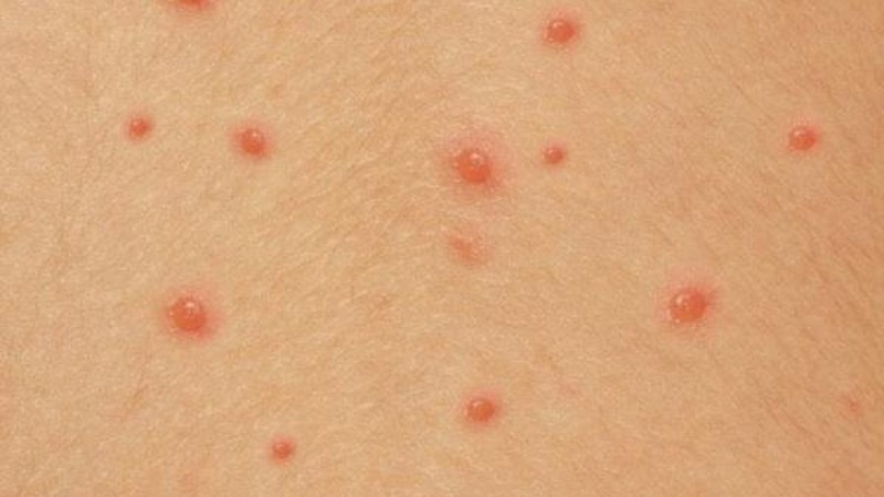 Khi bị u mềm lây sẽ xuất hiện các nốt mụn nhỏ màu hồng kèm theo ngứa 