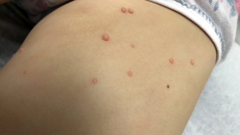Nổi mụn ở đùi hay bộ phận sinh dục cũng là một triệu chứng điển hình của  u mềm lây 
