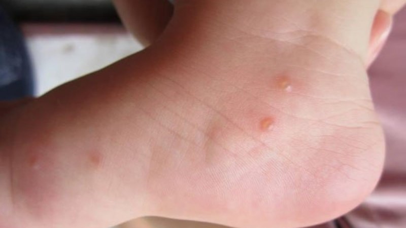 U mềm lây gây ra các vết sưng ở mặt, chân, tay 