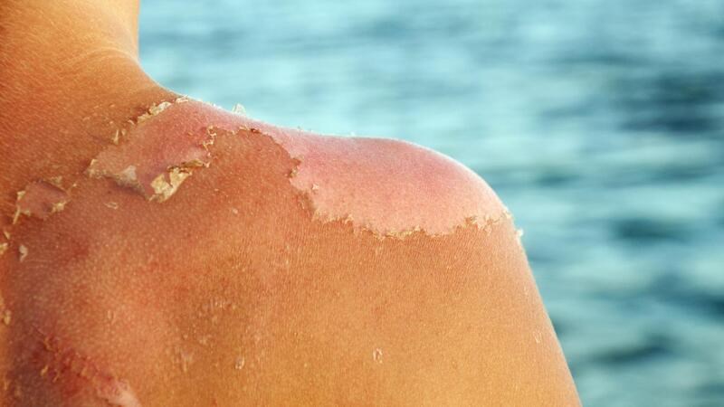 Chữa cháy nắng bỏng nhẹ là một công dụng nổi bật của dầu mù u 