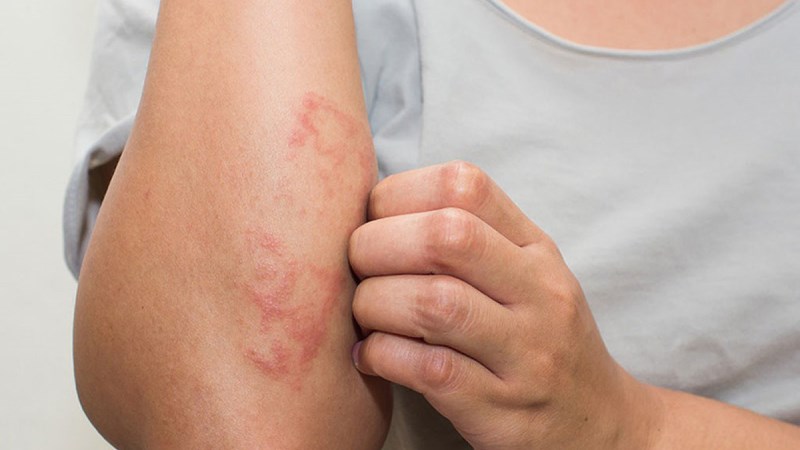 Nhờ khả năng kháng khuẩn và chống viêm nên dầu mù u cũng có tác dụng tốt trong việc điều trị bệnh chàm 