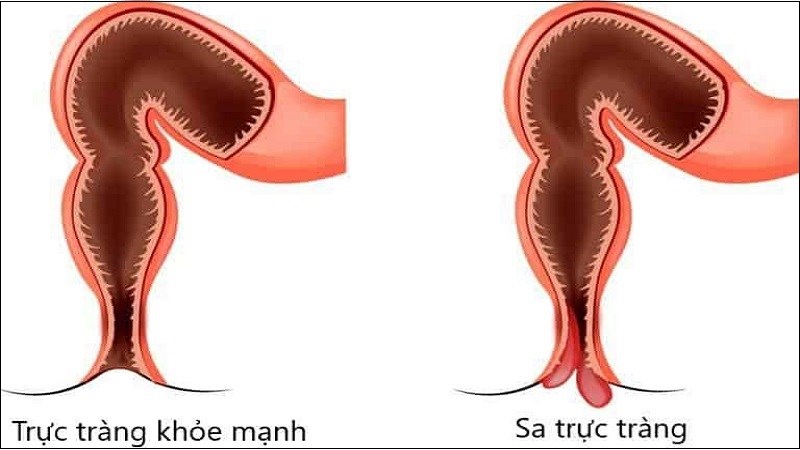 Bệnh Kiết Lỵ Có Tự Khỏi Không? Tìm Hiểu Nguyên Nhân Và Cách Điều Trị