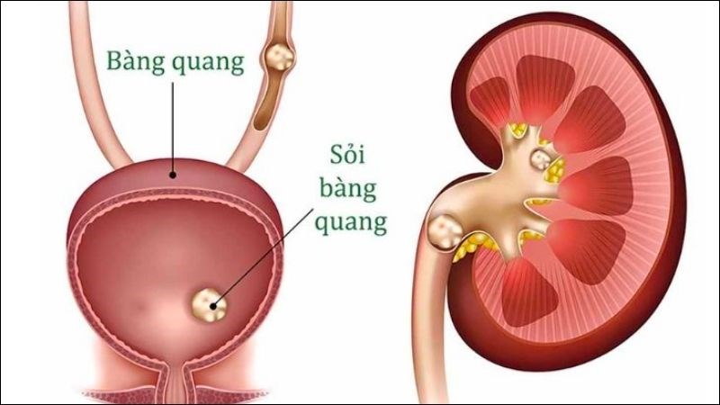 Sỏi bàng quang là gì?