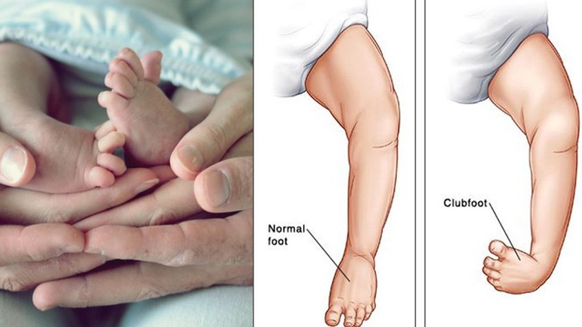 Hiện tượng chân vòng kiềng