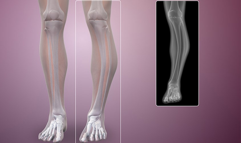 Trẻ nhỏ nếu mắc bệnh Paget sẽ có nguy cơ chân vòng kiềng