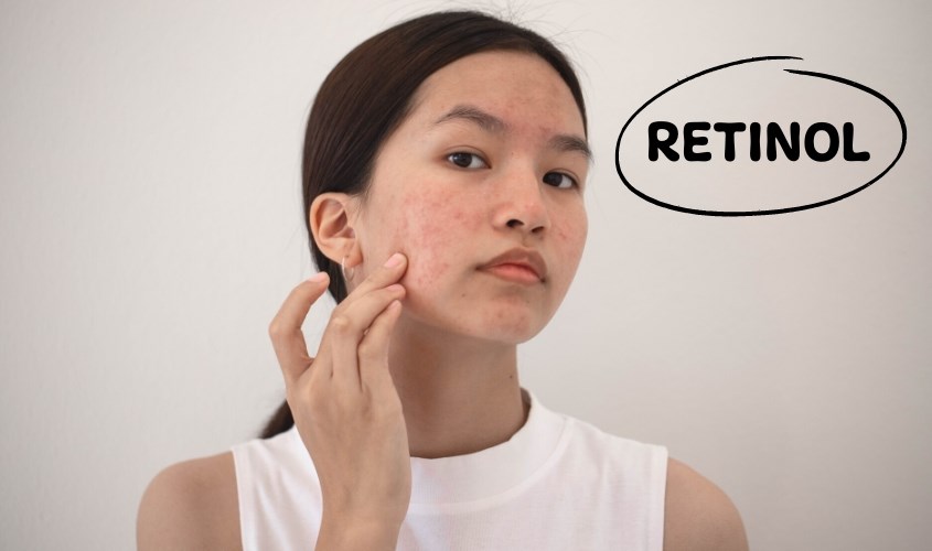 Bạn nên chọn sản phẩm có chứa retinol để điều trị mụn ẩn