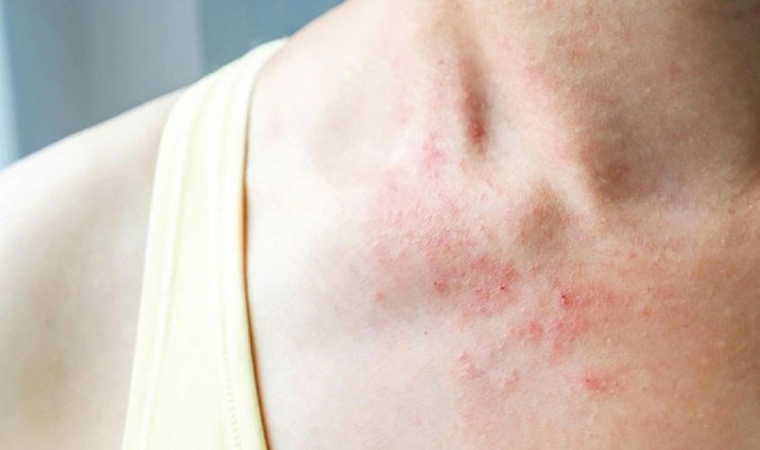 Dẫn đến nguy cơ mắc các vấn đề về ngoài da chẳng hạn như bệnh chàm