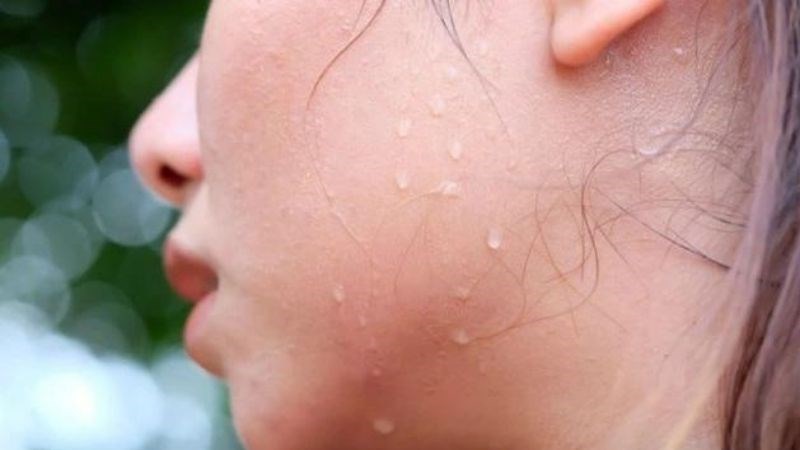 Sau mỗi cơn sốt, người bệnh thường đổ rất nhiều mồ hôi
