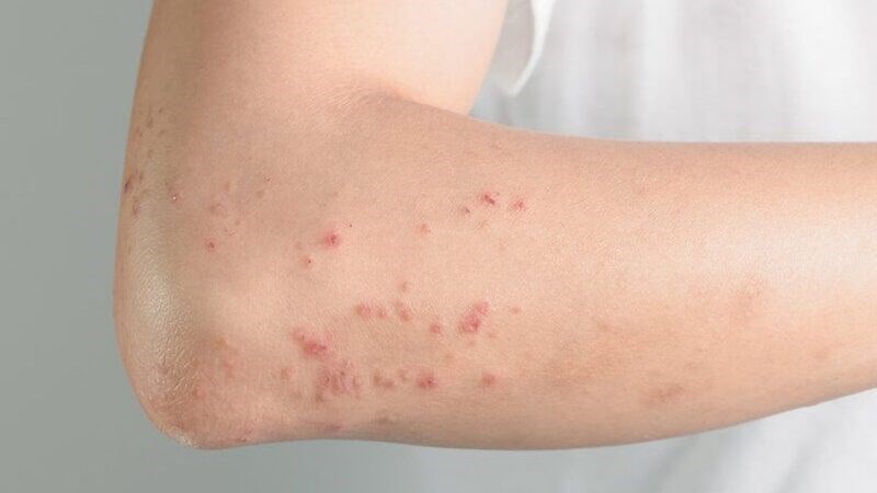 Việc phát ban trên da cho thấy thời kỳ ủ bệnh và phát bệnh đã qua